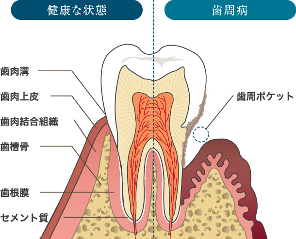 歯周病治療｜北光歯科クリニック